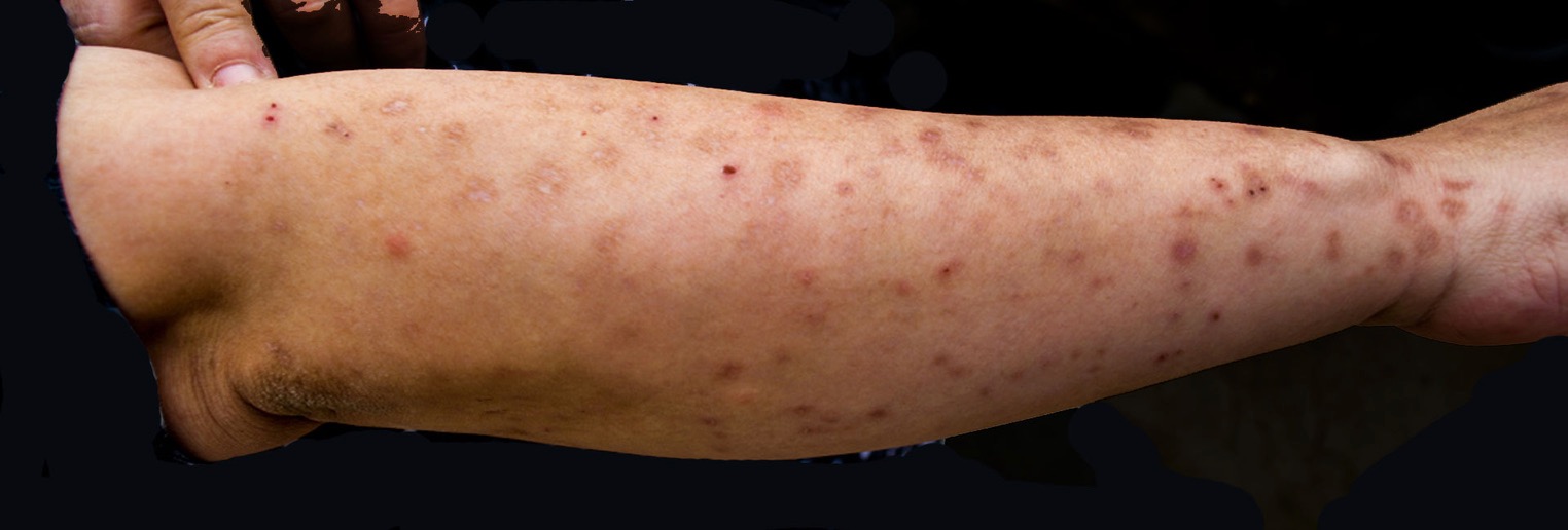 bed bug bite photo bed bug bites