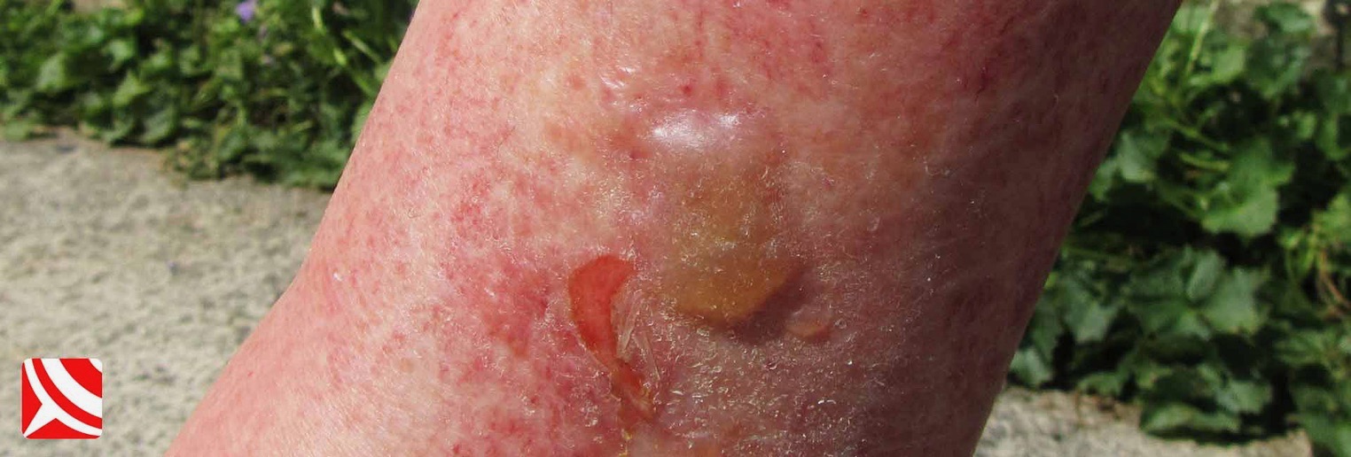 Bee sting allergic reaction